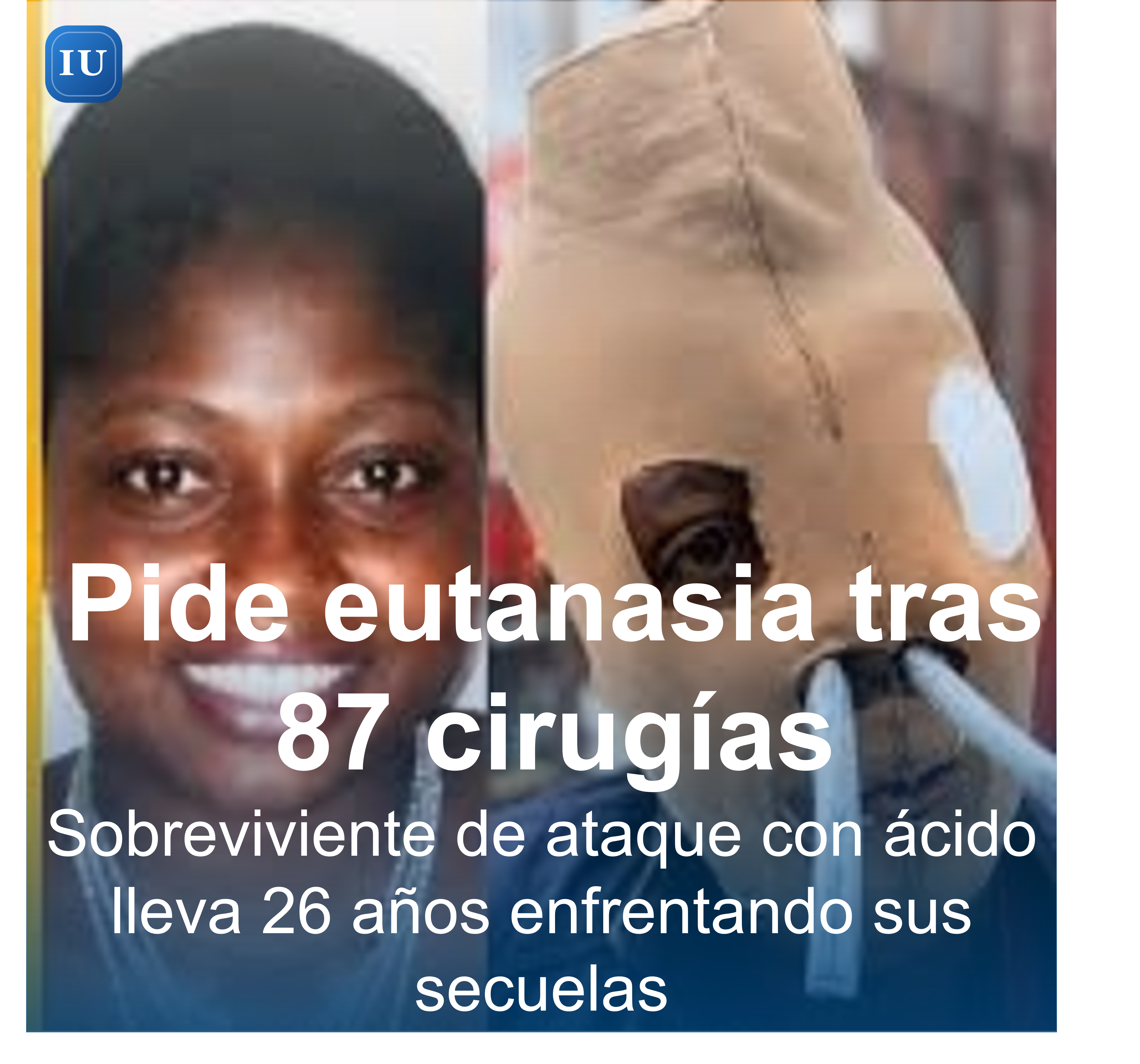 Sobreviviente de ataque con ácido lleva 26 años enfrentando sus secuelas